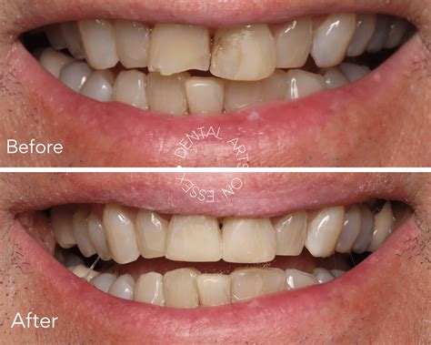 Before And After - Dental Arts on Essex