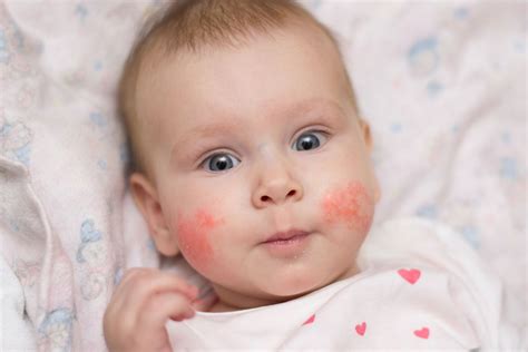 Alergia Alimentar Dermatite Atópica Bebe - Dermatite atópica em bebê: o que é, sintomas, causas e tratamento - Tua ...
