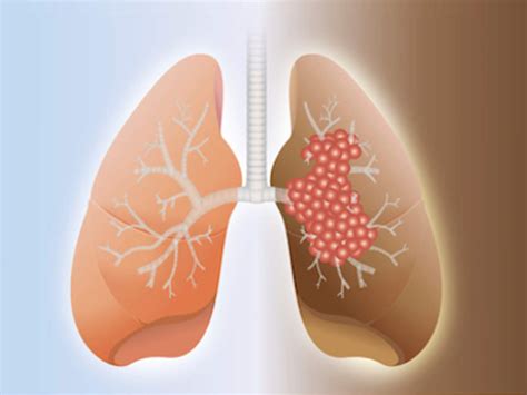 Different Types Lung Cancer