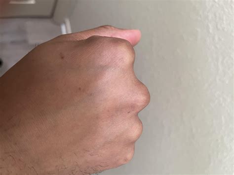 Are these bed bug bites or an allergic reaction? I keep getting these