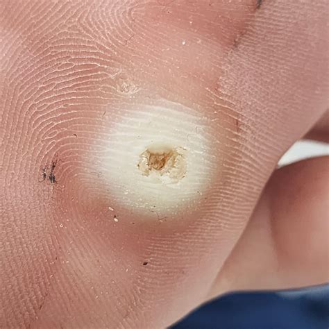 foot corn rdermatologyquestions