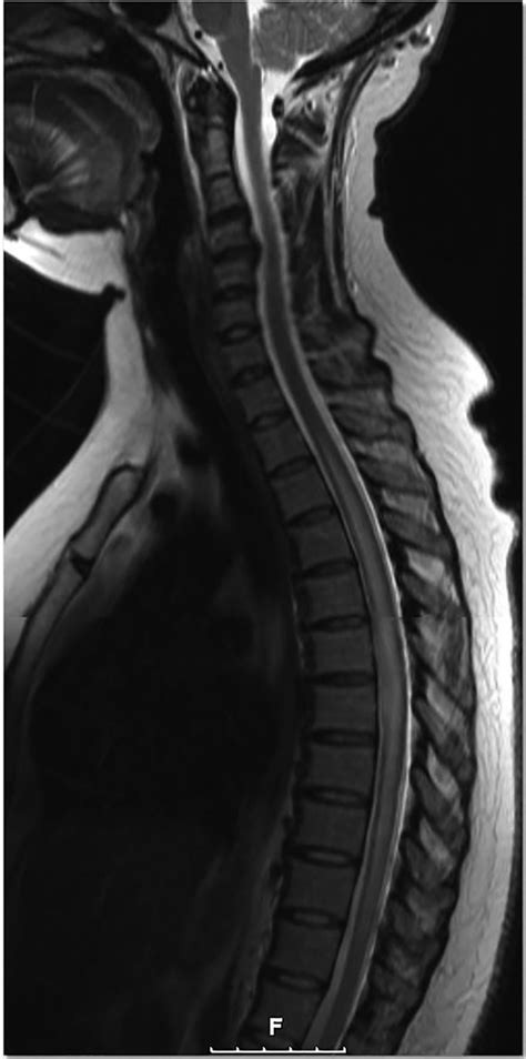 longitudinally extensive transverse myelitis  rare association