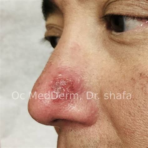 Shingles On Lips And Nose | Lipstutorial.org