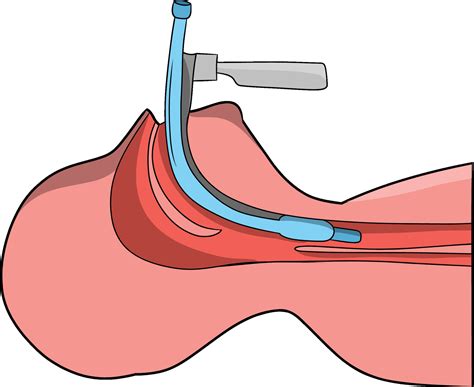 A Hand drawn Illustration of a Medical Endotracheal Intubation 27560540