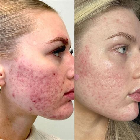 Acne Gallery — Nu Image Medical Esthetics