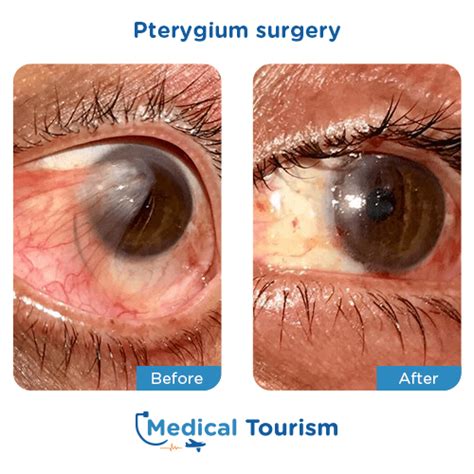 eye doctors  pterygium surgery medical tourism