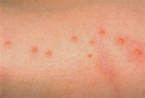What Do Mosquito Bites Look Like After A Few Days at Joyce Krebs blog