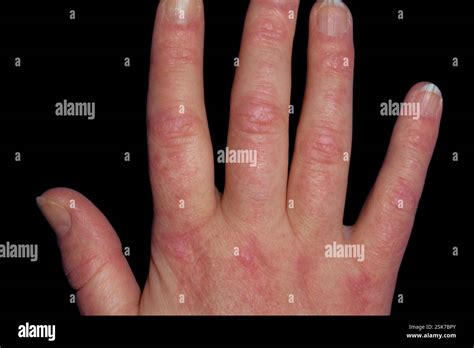 dermatomyositis close   red inflamed areas gottrons papules