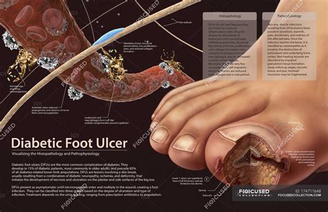 Diabetic Foot Diagram