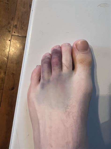 Stubbed my toe : r/Wellthatsucks