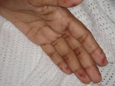 Osler Nodes Vasculitis