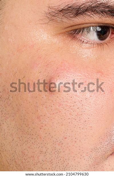 425 Sebaceous Cyst Images, Stock Photos & Vectors | Shutterstock