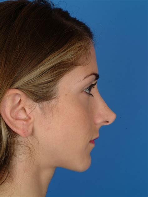 revision rhinoplasty  correct pointy nose projected tip facial