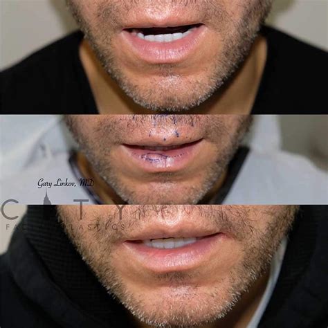 How To Reduce Lips Without Surgery | Lipstutorial.org