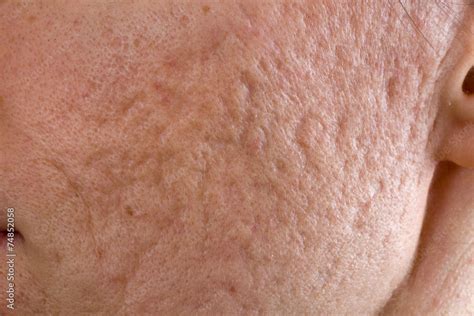 acne scars  cheek stock photo adobe stock