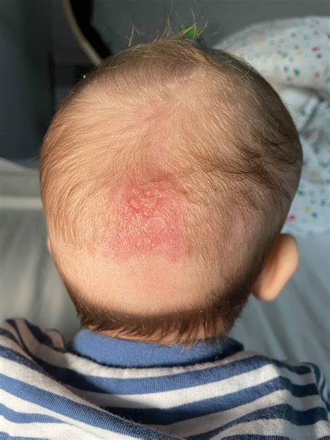 Why Does Cradle Cap Smell? (Everything You Need To Know) – Mr Bees Manuka