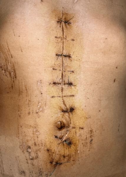 7 Abdominal Midline Incision Images, Stock Photos, 3D objects ...