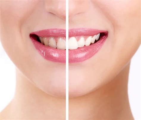 Woman teeth before and after whitening Stock Photo by ©Pixinooo 125752268