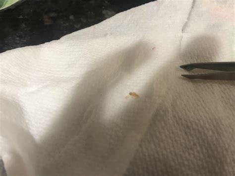 Watch as a huge large blackhead on back goes viral online 17