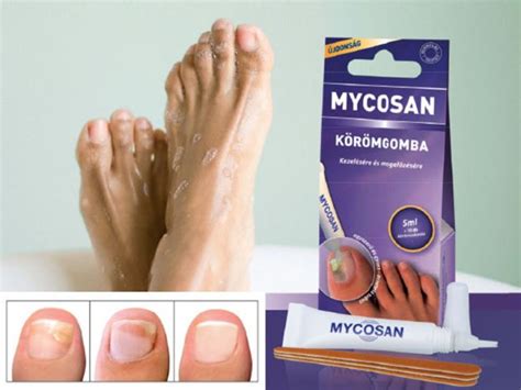Mikozan | Болки в ставите