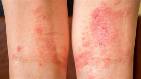 eczema  arms