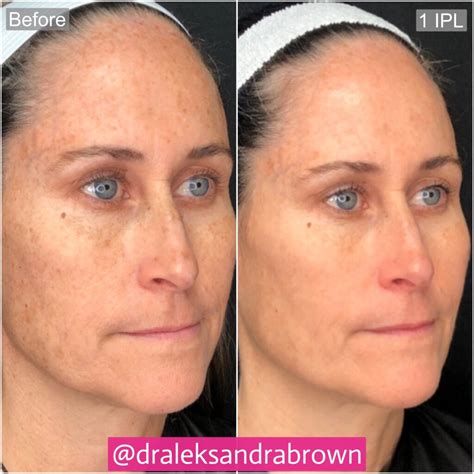 optimized light  laser technology river ridge dermatology