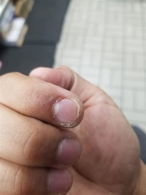 My right hand index finger tip becomes really dry, and gets thick nails