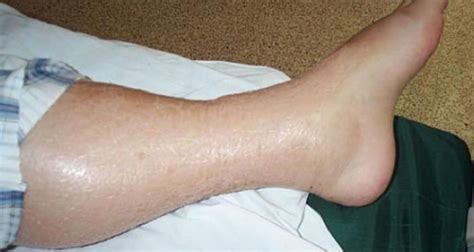 bengkak air punca simptom  rawatan  diagnosa