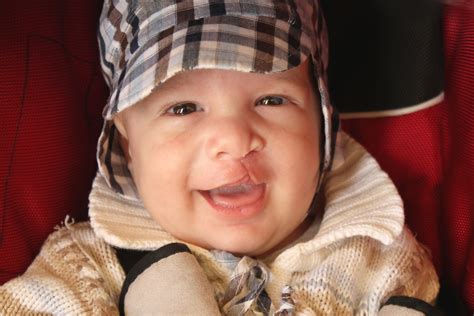 cleft lip dentist  newbury park