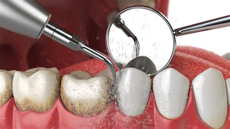 Dental Scaling - Dr Jamilian