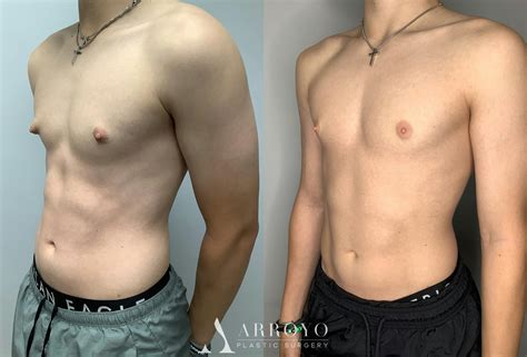 Gynecomastia Before & After Photos | Arroyo Plastic Surgery