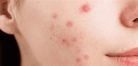 Fungal Acne Causes Symptoms and Treatment Options