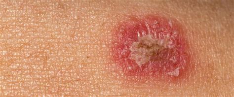 Ringworm: Everything You Need to Know