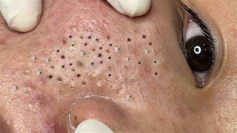 Forget Everything You Know: Unbelievable Blackhead Removal 2024 Revealed - 28714fm