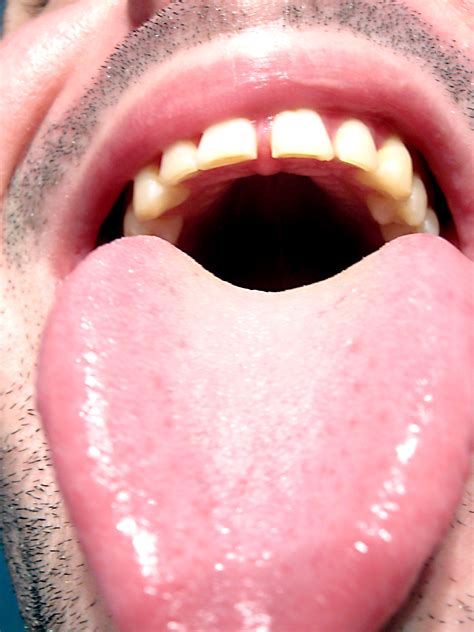 Normal Tongue Vs Thrush