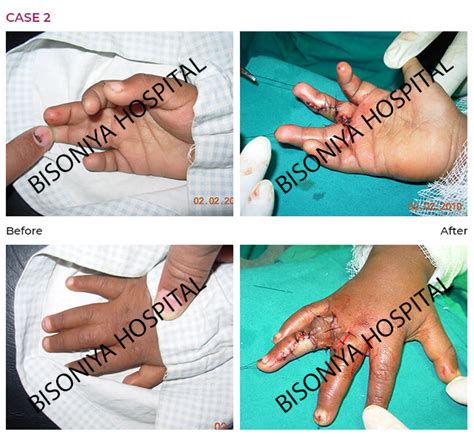 Syndactyly / Polydactyly - Plastic Surgery