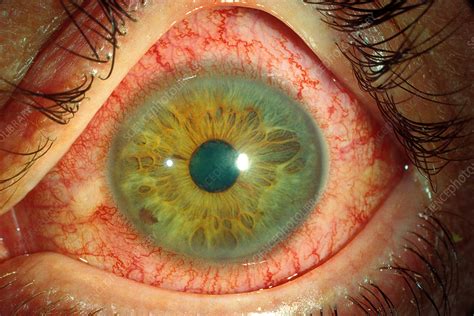 uveitis