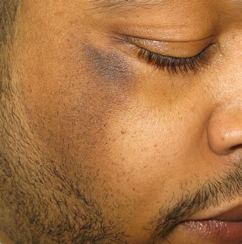 acanthosis nigricans