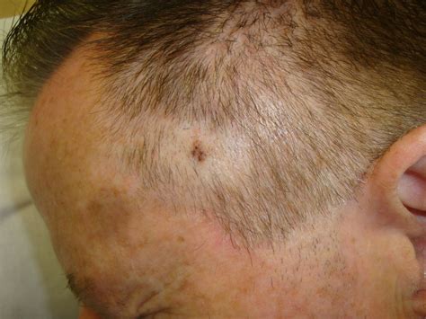 skin cancer scalp