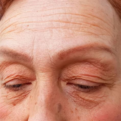 Fine Lines and Wrinkles Removal Abu Dhabi - Anti Aging Treatment