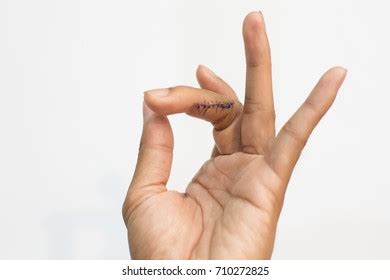 how to take care of stitches on finger