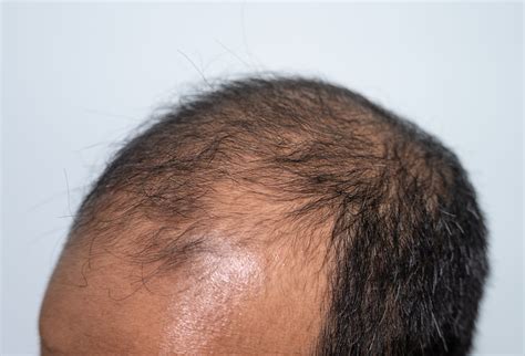 Genetic and Hair Loss: Understanding Hereditary Factors