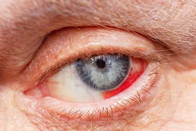 derrame ocular cinfasalud