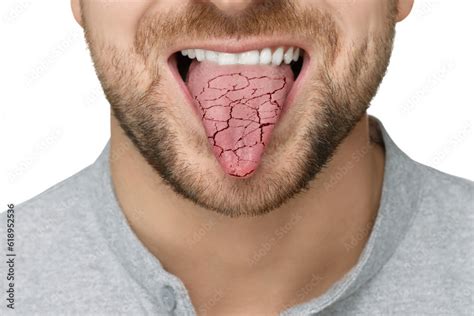dry mouth symptom man showing dehydrated tongue  white background