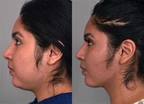 Cheek Liposuction and Permanent Facial Contouring in NYC