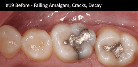 Composite Resin Filling Before & After Photos | Los Angeles CA
