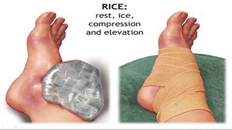 Sprained Ankle Treatment