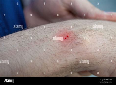 Male hand with the wound from snake bite or snakebite. Bite marks with ...