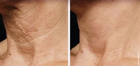 Greenspring Medical AestheticsPlasma Pen Skin Tightening | Greenspring Medical Aesthetics