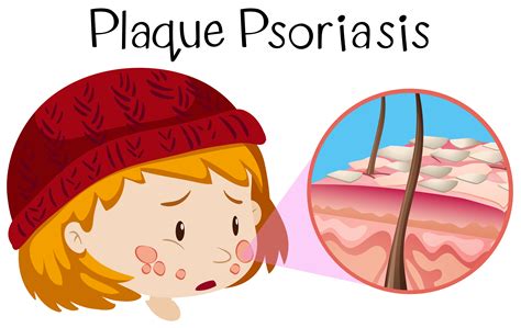 Human Anatomy of Plaque Psoriasis 293104 Vector Art at Vecteezy